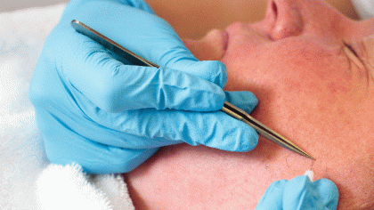 Elektrische epilatie